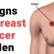 8 Signs of Breast Cancer In Men
