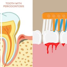 Dentist Explains 10 Ways to Treat Bleeding Gums