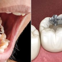 Researchers Explain Why You Should Never Get Silver Fillings