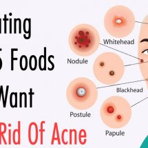 Stop Eating These 5 Foods If You Want To Get Rid Of Acne