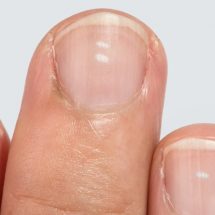 8 Health Warnings to Never Ignore From Your Fingernails