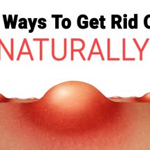 8 Easy Ways To Get Rid Of Acne Naturally