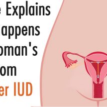 Science Explains What Happens to A Woman’s Body from A Copper IUD