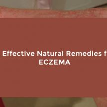 15 Effective Natural Remedies for Eczema