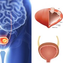 15 Hidden Signs of Bladder Cancer to Never Ignore