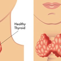 7 Life Changes That Can Help a Thyroid Condition