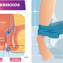 7 Symptoms of Hemorrhoids to Never Ignore