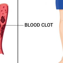 10 Early Warning Symptoms of a Blood Clot You Should Never Ignore