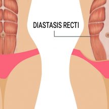 3 Signs of Diastasis Recti (And How to Fix It)