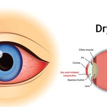 4 Easy Ways to Heal Dry Eyes Naturally