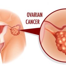 5 Early Warning Signs of Ovarian Cancer to Never Ignore