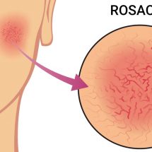 5 Early Warning Signs of Rosacea (and How to Treat It)