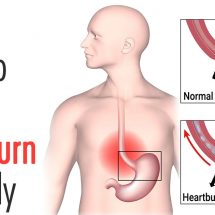 5 Easy Ways to Stop Heartburn Naturally