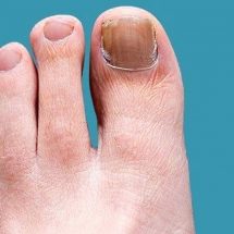 How to Prevent and Treat Toenail and Foot Fungus