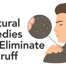 7 Natural Remedies That Eliminate Dandruff