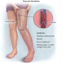 Deep vein thrombosis : causes, symptoms and treatment