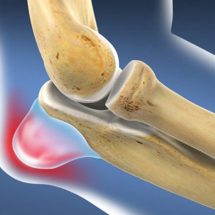 Inflammation of the elbow joint: Causes, symptoms and methods and treatment