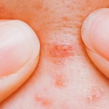 Researchers Explain What Getting Pimples Says About Your Health