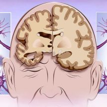 The 5 Stages of Alzheimer’s Disease