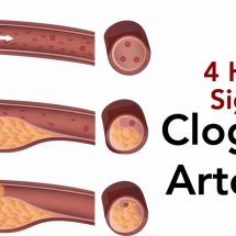 4 Hidden Signs of Clogged Arteries (And The Best Foods to Prevent It)