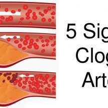 5 Signs Of Clogged Arteries