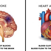 Avoid A Heart Attack or Stroke: 10 Foods to Never Ignore