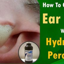 Easy Removal Of Earwax With Hydrogen Peroxide