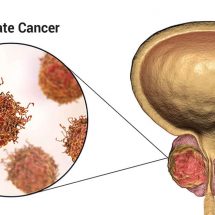 Researchers Reveal That Men With High Testosterone Are Almost 20% More Likely to Get Prostate Cancer