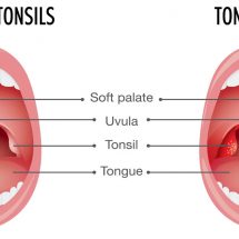 10 Early Signs of Tonsillitis (And How to Get Rid of It)