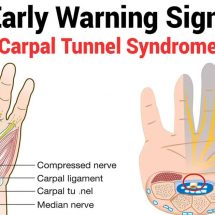 10 Early Warning Signs of Carpal Tunnel Syndrome