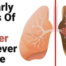 12 Early Signs Of Lung Cancer To Never Ignore