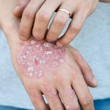 12 Foods that Make Eczema Worse