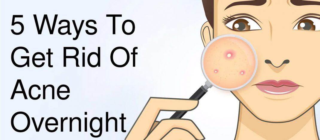5 Ways To Get Rid Of Acne Overnight