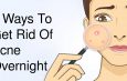 5 Ways To Get Rid Of Acne Overnight