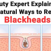 Beauty Expert Explains 15 All Natural Ways to Remove Blackheads