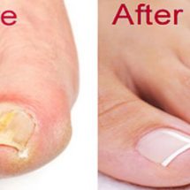 Get Rid of Nail Fungus Forever – 2 Ingredient Recipe