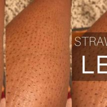 How to Get Rid of Strawberry Legs