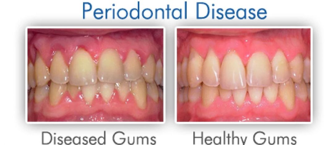 What Is Periodontitis? Causes, Symptoms, And Treatment