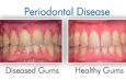 What Is Periodontitis? Causes, Symptoms, And Treatment