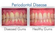 What Is Periodontitis? Causes, Symptoms, And Treatment