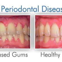 What Is Periodontitis? Causes, Symptoms, And Treatment