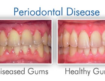 What Is Periodontitis? Causes, Symptoms, And Treatment